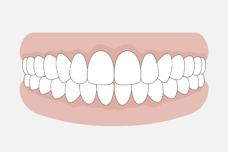 上下の歯が均等に接触